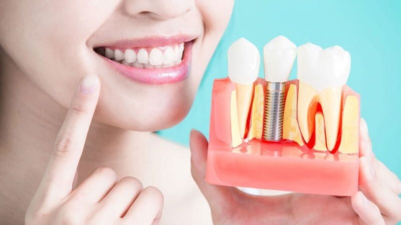 The Advantages And Disadvantages Of Dental Implants